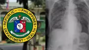 DOH Reiterates Call for Early TB Screening to Combat Spread on World TB Day
