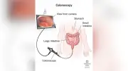 Why Normal Tumor Markers Still Require a Colonoscopy: Dr. Fritz Explains